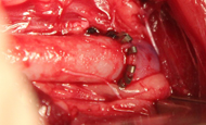 ArteryStaple